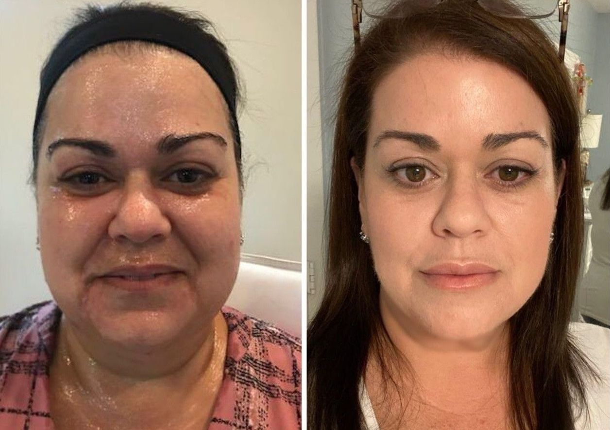 microneedling with radiofrequency, Before and After, Monaco Medspa in Midtown Edgewater Miami, FL, Morpheus8 Face, Morpheus8 Eyelids, Morpheus8  Neck, Photos of Before and After Morpheus8, Monaco med spa in Midtown Edgewater Miami, FL