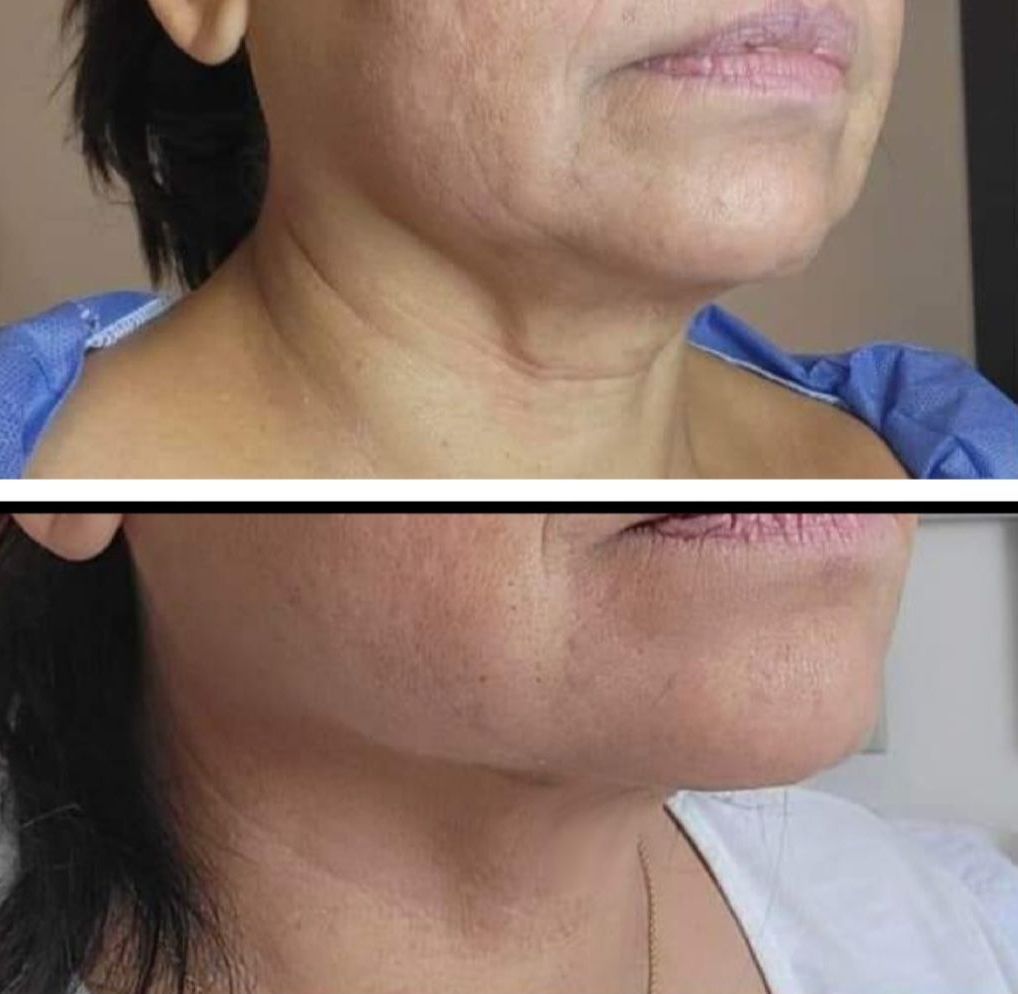 microneedling with radiofrequency, Before and After, Monaco Medspa in Midtown Edgewater Miami, FL, Morpheus8 Jowls, Morpheus8 lower face, morpheus8 Neck, Photos of Before and After Morpheus8, Monaco med spa in Midtown Edgewater Miami, FL