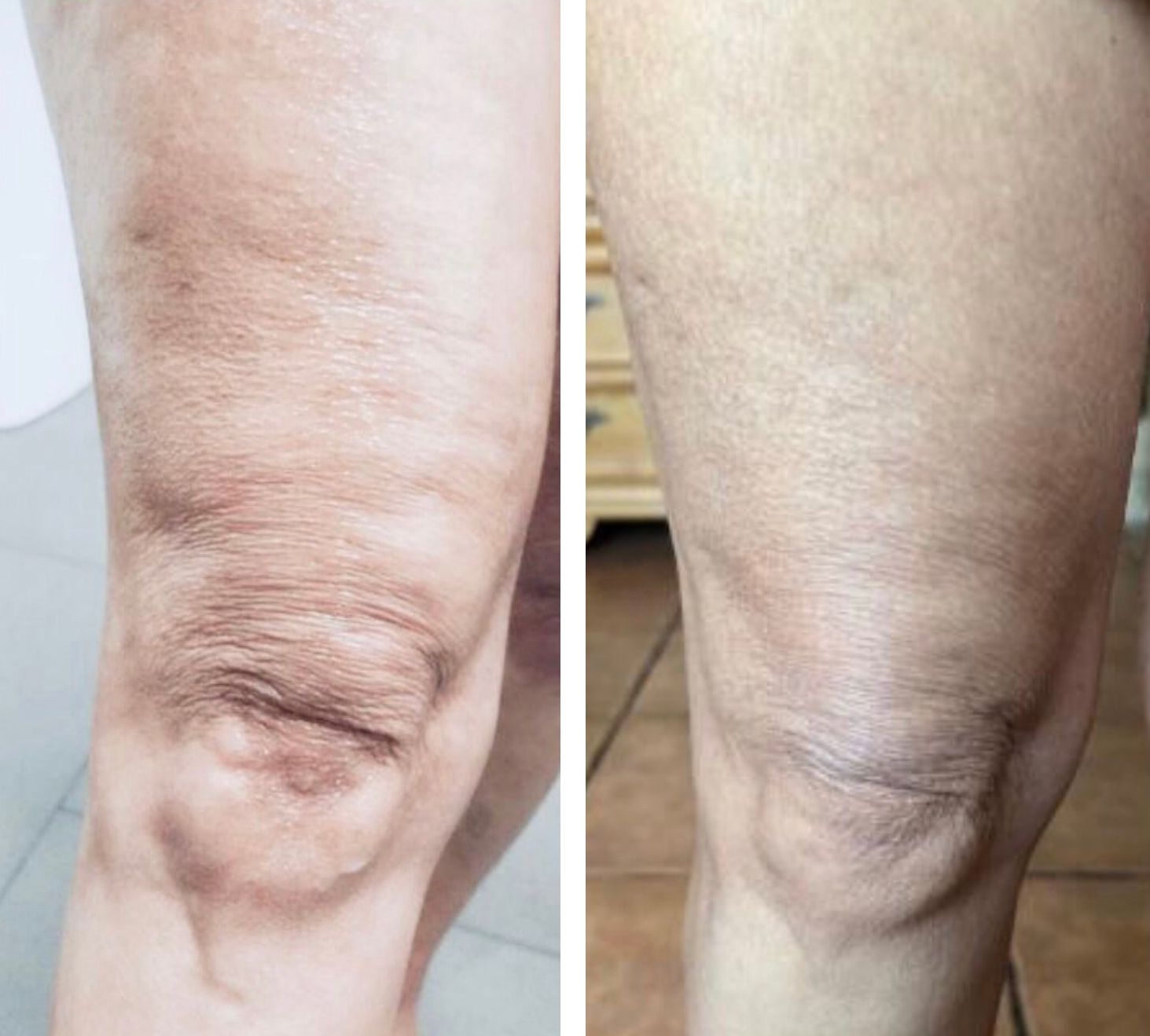 Morpheus8 knees, body contouring, body sculpting, microneedling with radiofrequency, Before and After, Monaco Medspa in Midtown Edgewater Miami, FL, Photos of Before and After Morpheus8, Monaco med spa in Midtown Edgewater Miami, FL