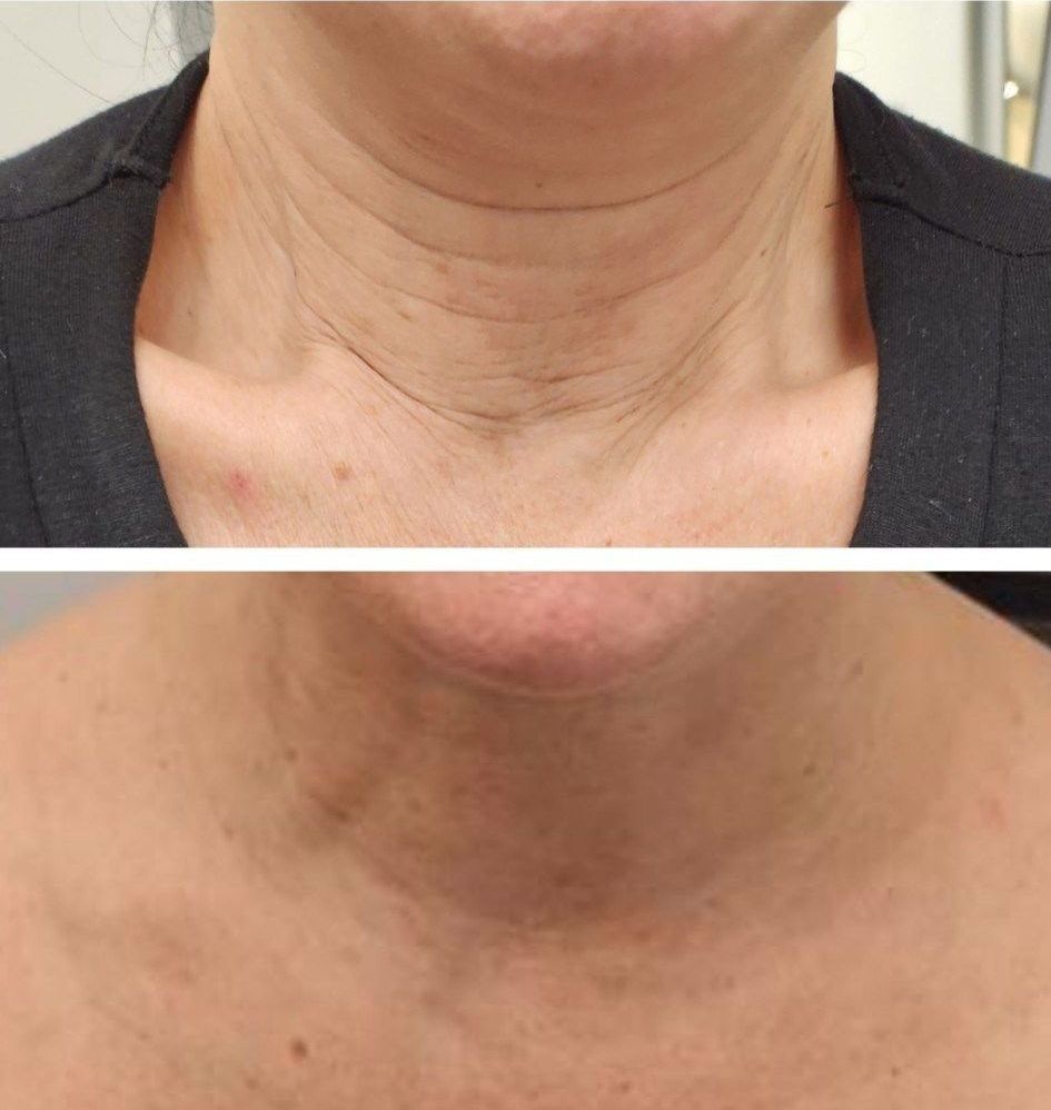 microneedling with radiofrequency, Before and After, Monaco Medspa in Midtown Edgewater Miami, FL, Morpheus8 Neck, Photos of Before and After Morpheus8, Monaco med spa in Midtown Edgewater Miami, FL