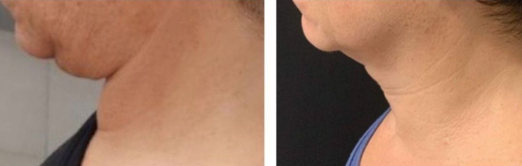 microneedling with radiofrequency, Before and After, Monaco Medspa in Midtown Edgewater Miami, FL, Morpheus8 Neck, Photos of Before and After Morpheus8, Monaco med spa in Midtown Edgewater Miami, FL