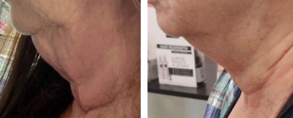 microneedling with radiofrequency, Before and After, Monaco Medspa in Midtown Edgewater Miami, FL, Morpheus8 Neck, Photos of Before and After Morpheus8, Monaco med spa in Midtown Edgewater Miami, FL