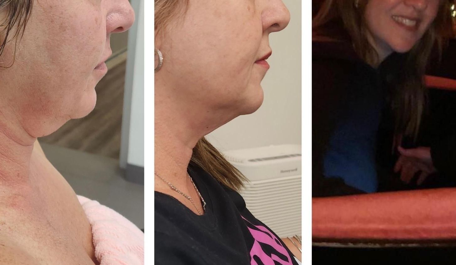 microneedling with radiofrequency, Before and After, Monaco Medspa in Midtown Edgewater Miami, FL,  Morpheus8 Face, Morpheus8  Eyelids, Morpheus8  Neck, Photos of Before and After Morpheus8, Monaco med spa in Midtown Edgewater Miami, FL