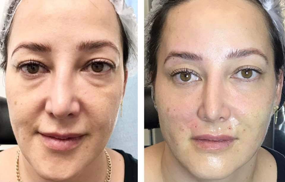 Monaco Med Spa, Miami, FL, Before and After, Midtown miami, Edgewater Miami, FL, PDO nonsurgical Thread faceLift and necklift, face lift, Monaco med spa in downtown worldcenter edgewater midtown Miami, FL, photo of Before and After pdo thread nonsurgical facelift, face lift. neck lift, and neck lift  Midtown Miami, FL