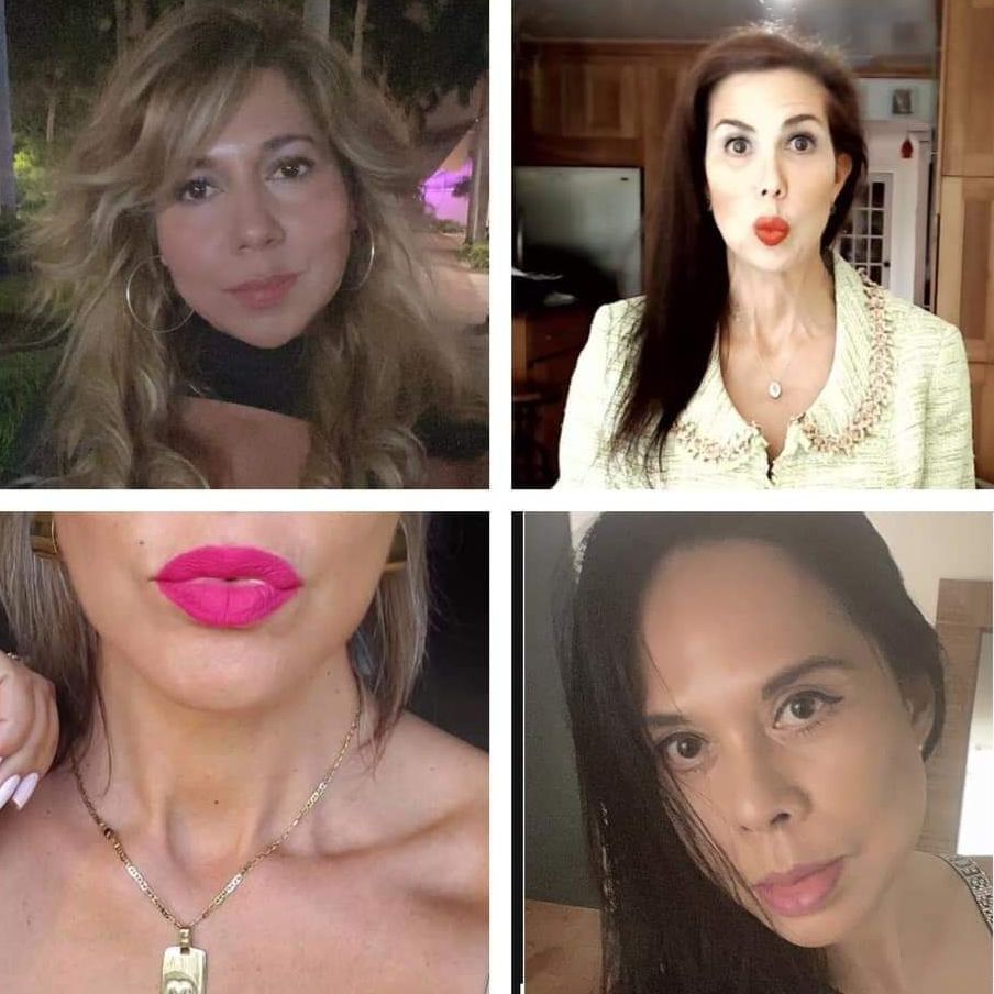 Monaco Med Spa, Miami, FL, Before and After, Midtown miami, Edgewater Miami, FL, PDO nonsurgical Thread faceLift and necklift, face lift, neck lift Monaco med spa in downtown worldcenter edgewater midtown Miami, FL, photo of Before and After pdo thread nonsurgical facelift, face lift. neck lift, and neck lift  Midtown Miami, FL