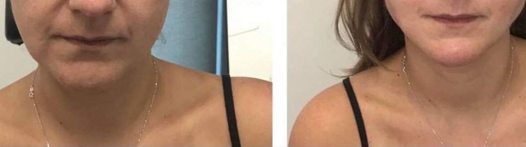 Monaco Med Spa, Miami, FL, Before and After, Midtown miami, Edgewater Miami, FL, PDO nonsurgical Thread faceLift and necklift, face lift, neck lift Monaco med spa in downtown worldcenter edgewater midtown Miami, FL, photo of Before and After pdo thread nonsurgical facelift, face lift. neck lift, and neck lift  Midtown Miami, FL