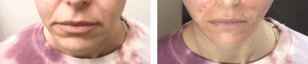 Monaco Med Spa, Miami, FL, Before and After, Midtown miami, Edgewater Miami, FL, PDO nonsurgical Thread faceLift and necklift, face lift, neck lift FL,  Monaco med spa in downtown worldcenter edgewater midtown Miami, FL, photo of Before and After pdo thread nonsurgical facelift, face lift. neck lift, and neck lift  Midtown Miami, FL