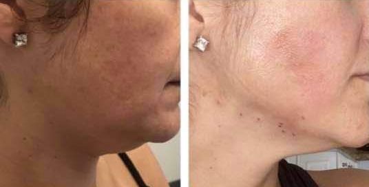 Monaco Med Spa, Miami, FL, Before and After, Midtown miami, Edgewater Miami, FL, PDO nonsurgical Thread faceLift and necklift, face lift, neck lift Monaco med spa in downtown worldcenter edgewater midtown Miami, FL, photo of Before and After pdo thread nonsurgical facelift, face lift. neck lift, and neck lift  Midtown Miami, FL