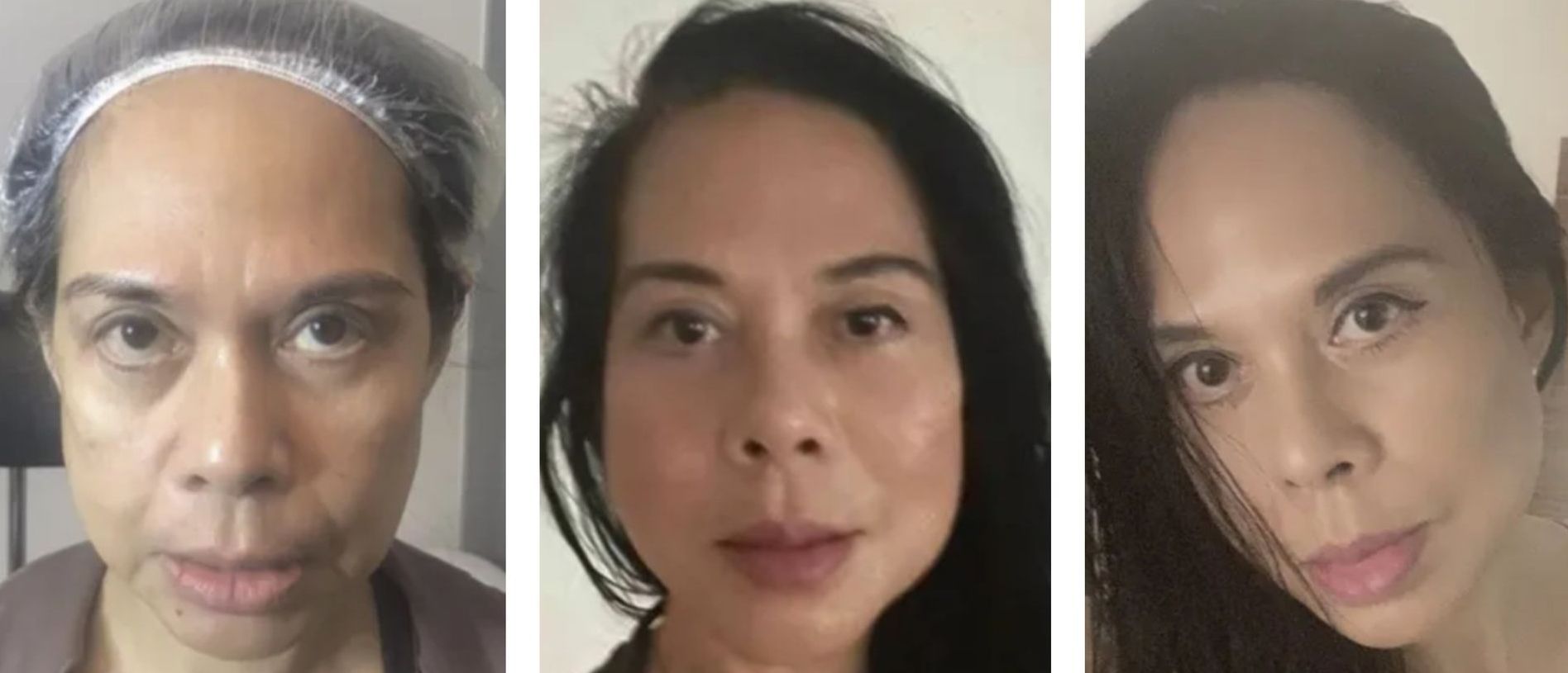 Monaco Med Spa, Miami, FL, Before and After, Midtown miami, Edgewater Miami, FL, PDO nonsurgical Thread faceLift and necklift, face lift, neck lift Monaco med spa in downtown worldcenter edgewater midtown Miami, FL, photo of Before and After pdo thread nonsurgical facelift, face lift. neck lift, and neck lift  Midtown Miami, FL