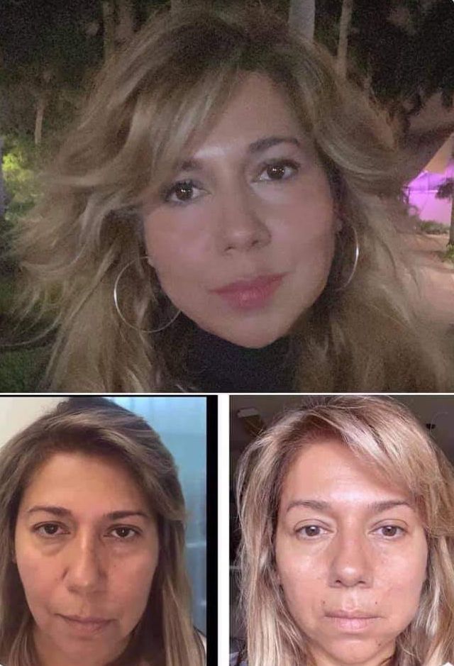 Monaco Med Spa, Miami, FL, Before and After, Midtown miami, Edgewater Miami, FL, PDO nonsurgical Thread faceLift and necklift, face lift, neck lift Monaco med spa in downtown worldcenter edgewater midtown Miami, FL, photo of Before and After pdo thread nonsurgical facelift, face lift. neck lift, and neck lift  Midtown Miami, FL