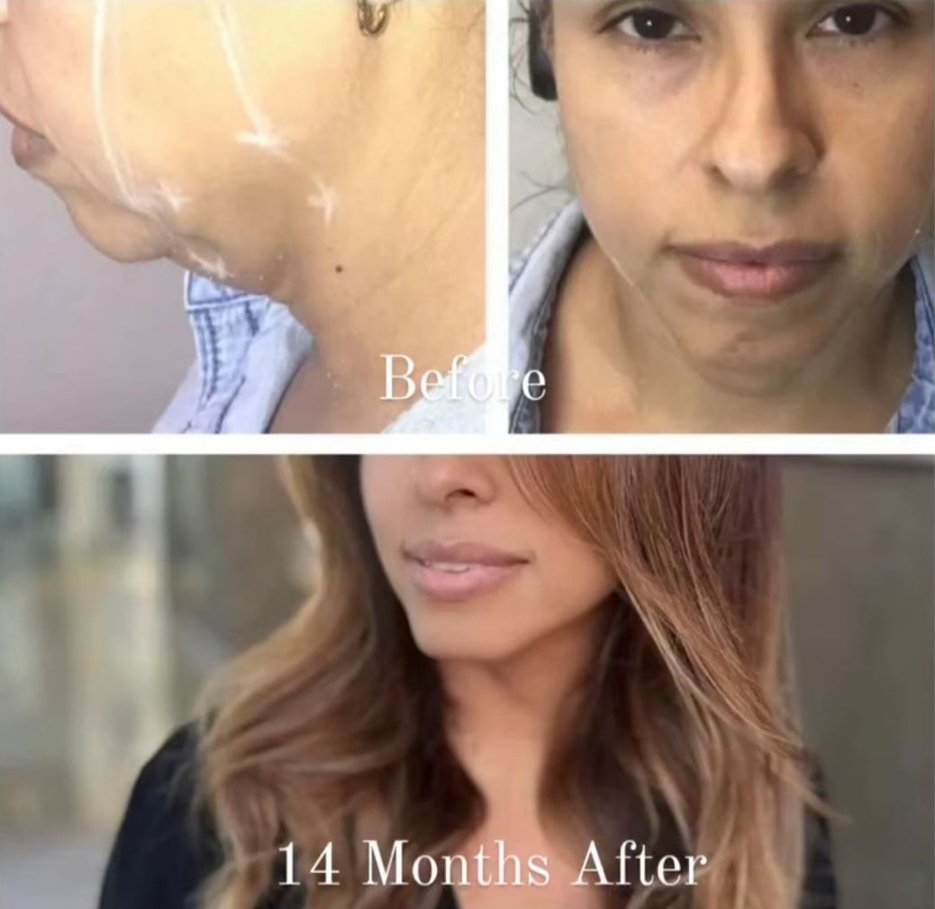 Monaco Med Spa, Miami, FL, Before and After, Midtown miami, Edgewater Miami, FL, PDO Thread Lift, Before PDO Thread Nonsurgical Jowl & Neck Lift, Monaco med spa in downtown worldcenter edgewater midtown Miami, FL, photo of Before and After pdo thread nonsurgical facelift, face lift. neck lift, and neck lift  Midtown Miami, FL