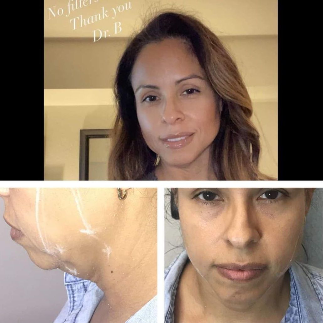 Monaco Med Spa, Miami, FL, Before and After, Midtown miami, Edgewater Miami, FL, PDO Thread Lift, Before PDO Thread Nonsurgical Jowl & Neck Lift, Monaco med spa in downtown worldcenter edgewater midtown Miami, FL,Monaco Med Spa, Miami, FL, photo of Before and After pdo thread nonsurgical pdo threadlift, pdo thread lift, facelift, face lift. neck lift, and neck lift  Midtown Miami, FL