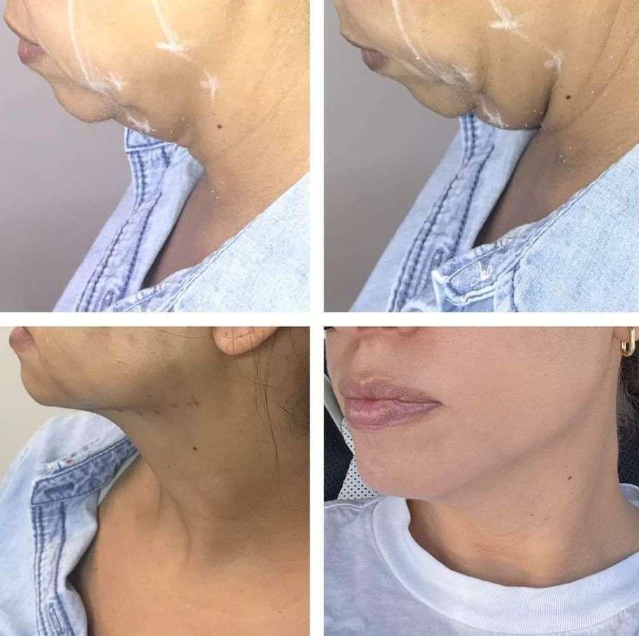 Monaco Med Spa, Miami, FL, photo of pdo thread Before and After of nonsurgical facelift, face lift. neck lift, and neck lift  Midtown Miami, Edgewater Miami, FL, PDO Thread Lift, pdo threadlift, Before PDO Thread Nonsurgical Jowl & Neck Lift, Monaco med spa in downtown worldcenter edgewater midtown Miami, FL