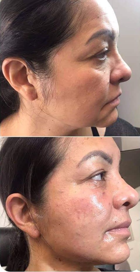 Monaco Med Spa, Miami, FL, Before and After, Midtown miami, Edgewater Miami, FL, PDO nonsurgical Thread faceLift and necklift, face lift, neck lift Monaco med spa in downtown worldcenter edgewater midtown Miami, FL, photo of Before and After pdo thread nonsurgical facelift, face lift. neck lift, and neck lift  Midtown Miami, FL