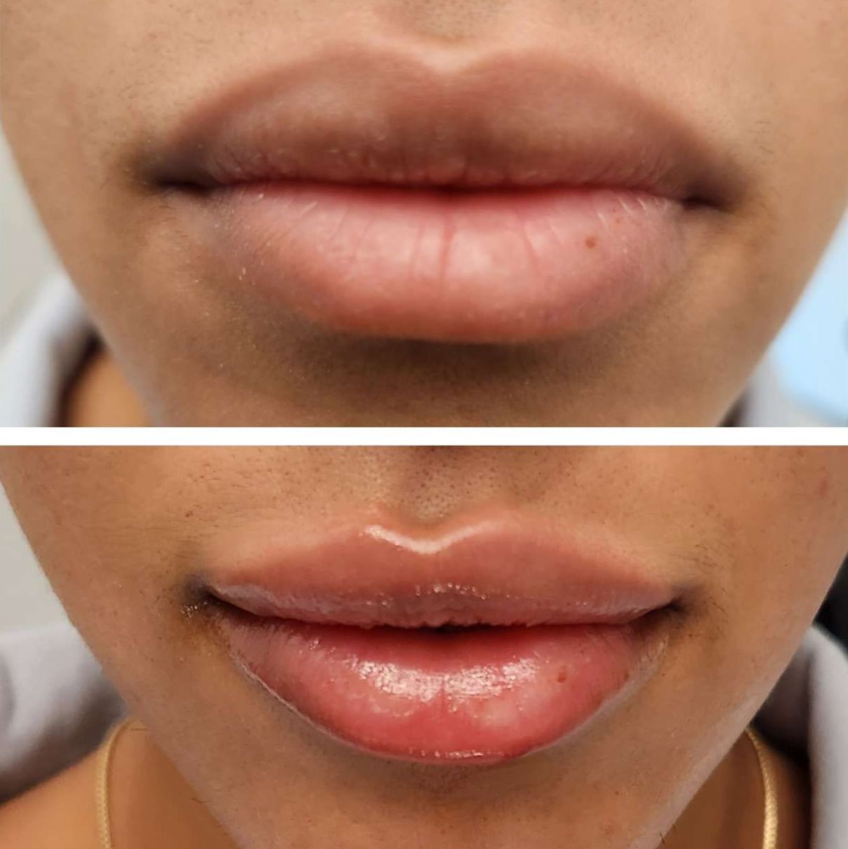 Before and after photo of lips. Top: thin, dark lips. Bottom: fuller, pink lips with lip filler  after lip filler injections perfomed by the best lip filler injector and cosmetic doctor in Miami, Fl, Dr. Barrueta, at the best med spa in Edgewater Miami, FL, Monaco MedSpa..