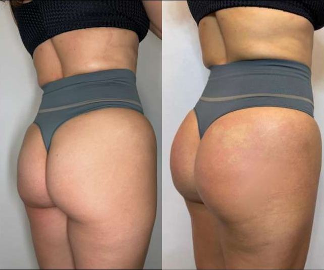 photo of Sculptra buttock butt lift, nonsurgical buttock butt lift bbl, by Dr. Barrueta the best sculptra butt lift doctor in Miami at the best med spa in Miami, Monaco MedSpa, Miami, FL, Before and After, Midtown miami, Edgewater Miami, FL,  Monaco med spa in downtown worldcenter edgewater midtown Miami, FL