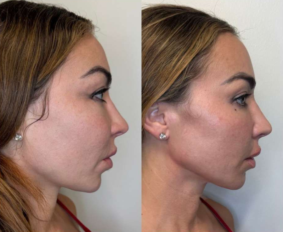 Photo of a client Before and Immediately After Jaw Contouring, Zygoma Cheek Filler and Lip Fillerperformed by the best cosmetic doctor in Miami, FL at the best med spa in Miami, Monaco MedSpa
