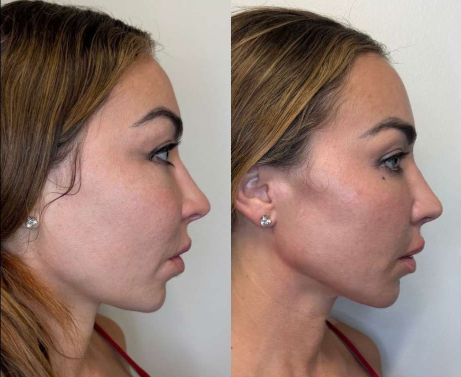 Before and Immediately After comparison photo of a female after Hyaluronic Acid (HA) Fillers for
Jaw Contouring, Zygoma Cheek Filler and Lip Filler by the best cosmetic doctor injector in Mimai Dr. Barrueta at the best med spa in Miami Monaco MedSpa