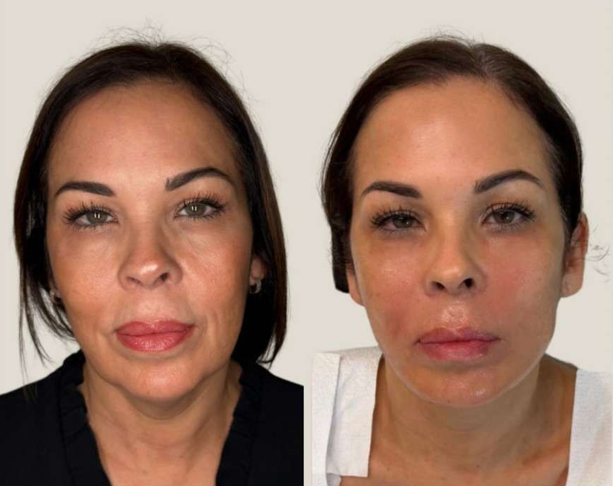 Image of a female face
Before and 3 Months After Hyaluronic Acid HA Fillers including  Jaw Contouring Filler,  Cheek Filler, Chin Filler and Periauricular Biostimulating Filler by Dr. Barrueta the best cosmetic doctor injector in Miami, FL at the best med spa in Miami, Monaco MedSpa