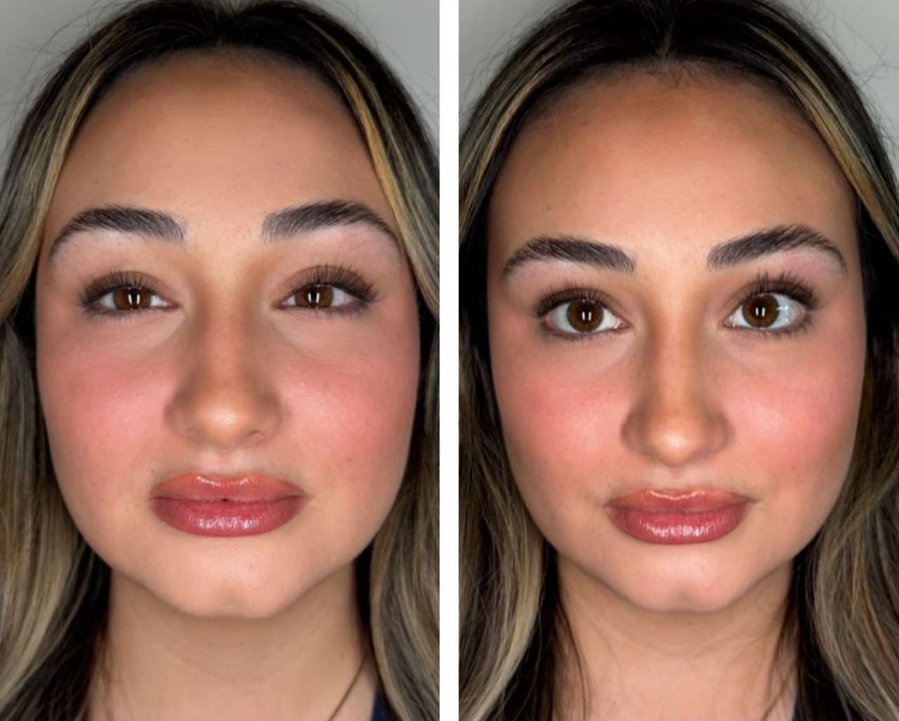 photo of UPNEEQ Before & 30 Minutes After,  at Monaco med spa, Miami, FL, midtown miami, edgewater miami, before and after Monaco med spa in downtown worldcenter edgewater midtown Miami, FL