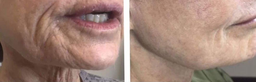 Monaco Med Spa, Miami, FL, photo of Before and After, Midtown miami, Edgewater Miami, FL, Plasma Pen
Before & 3 Months After One Treatment Session to Face and Neck with Plexr Plasma Pen