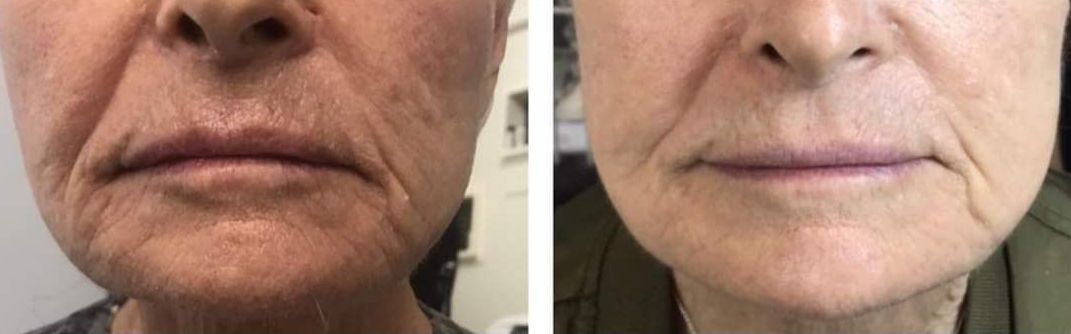 Monaco Med Spa, Miami, FL, photo of  Before and After, Midtown miami, Edgewater Miami, FL, Plasma Pen
Before & 3 Months After One Treatment Session to Face and Neck with Plexr Plasma Pen