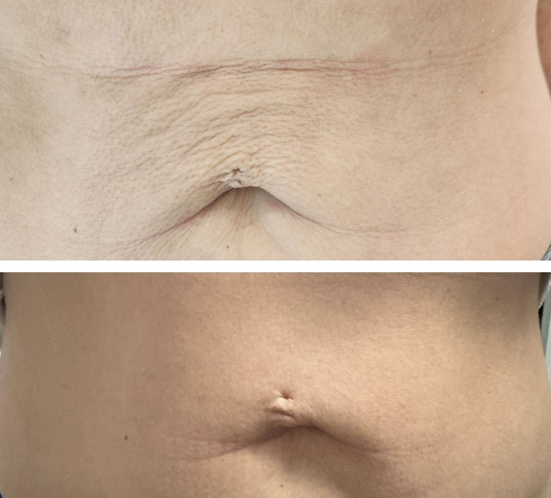 Monaco Med Spa, Miami, FL, photo of Before and After, Midtown miami, Edgewater Miami, FL, with Plexr Plasma Pen Abdomen/Stomach
Before & 9 Weeks After