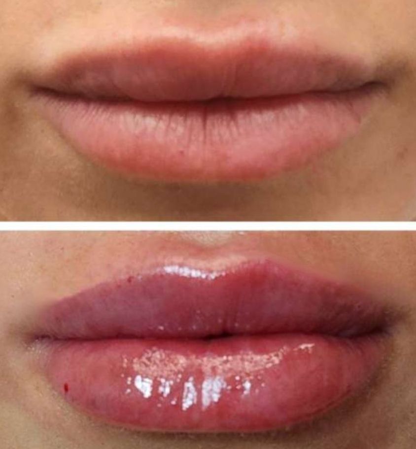 Photos of  Lip Filler, Before and Immediatelty After ip filler showing the most beuatiful lips in Miami, Fl injected with lip filler by the best cosmetic doctor in Miami, FL, Dr. Jeannette Barrueta, at the best med spa in Miami, FL, Monaco MedSpa,  near Midtown, Edgewater and Brickell