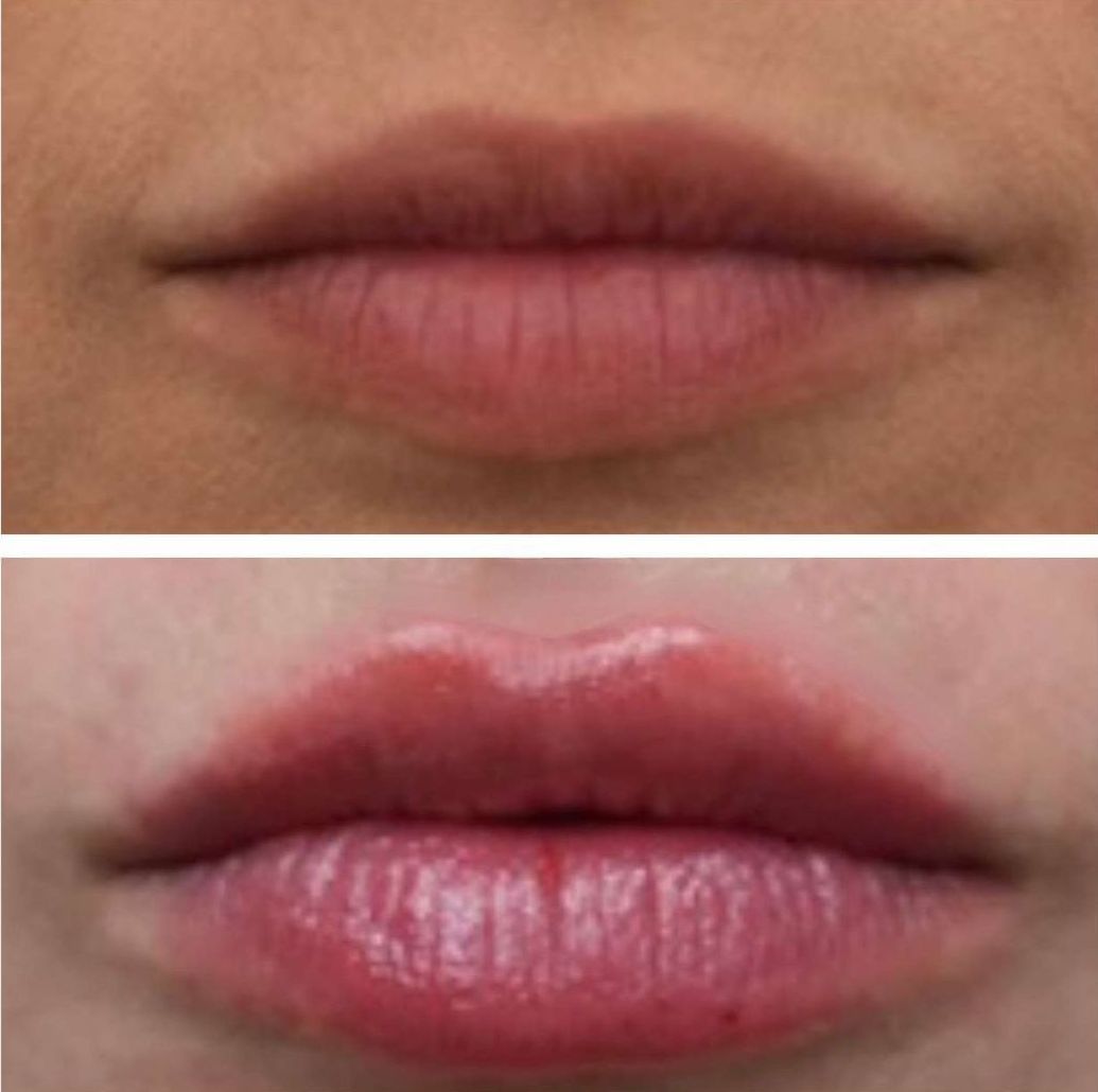 Comparison of lips: top is thinner, bottom is fuller and glossier  after lip filler injections perfomed by the best lip filler injector and cosmetic doctor in Miami, Fl, Dr. Barrueta, at the best med spa in Fisher Island Miami, FL, Monaco MedSpa.