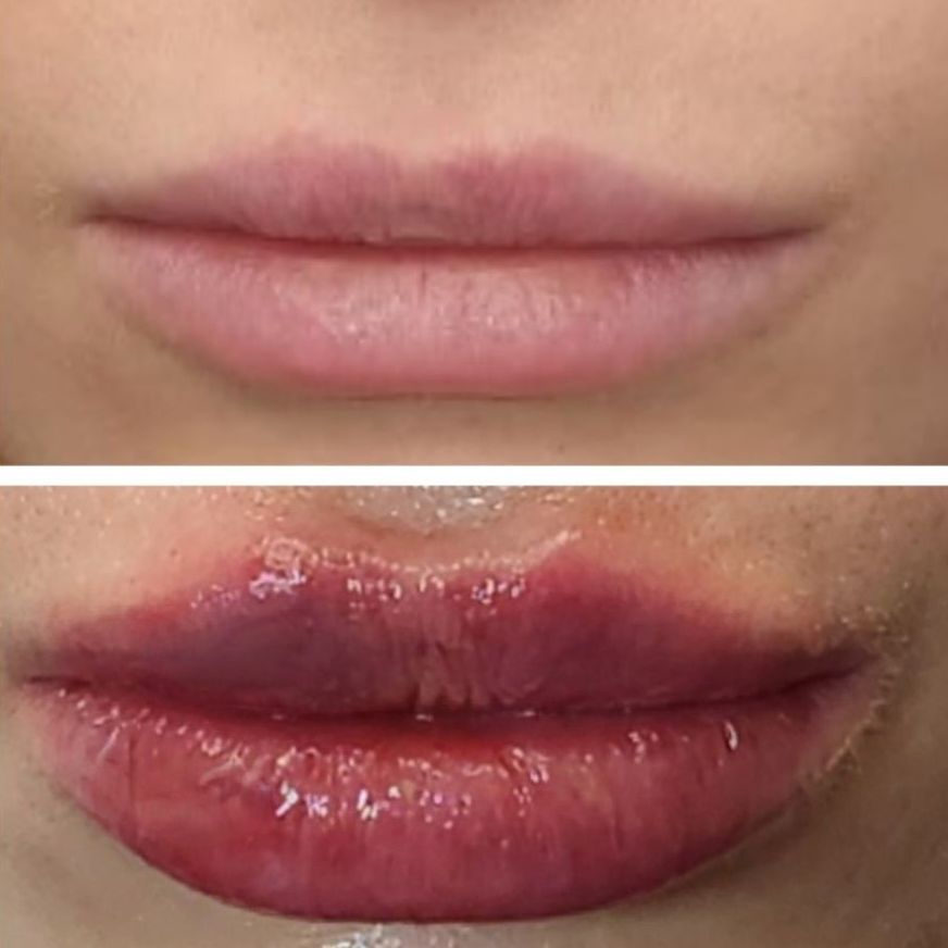 Before and after comparison of a person's lips. Top: thinner, pale pink. Bottom: fuller, red/purple, glossy after lip filler injections perfomed by the best lip filler injector and cosmetic doctor in Miami, Fl, Dr. Barrueta, at the best med spa in Wynwood Miami, FL, Monaco MedSpa..