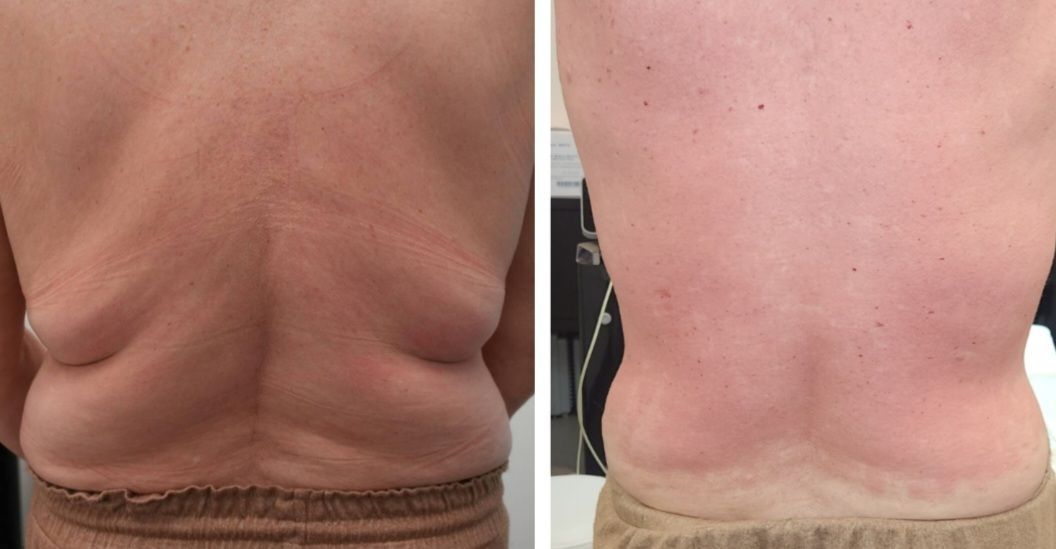 Monaco MedSpa, Miami, FL,  morpheus8 Back, morpheus8 Hips, Before and After Photo of morpheus8 microneedling with radiofrequency treatment. body contouring, body sculpting, microneedling with radiofrequency, Before and After, Monaco Medspa in Midtown Edgewater Miami, FL, Photos of Before and After Morpheus8, Monaco med spa in Midtown Edgewater Miami, FL