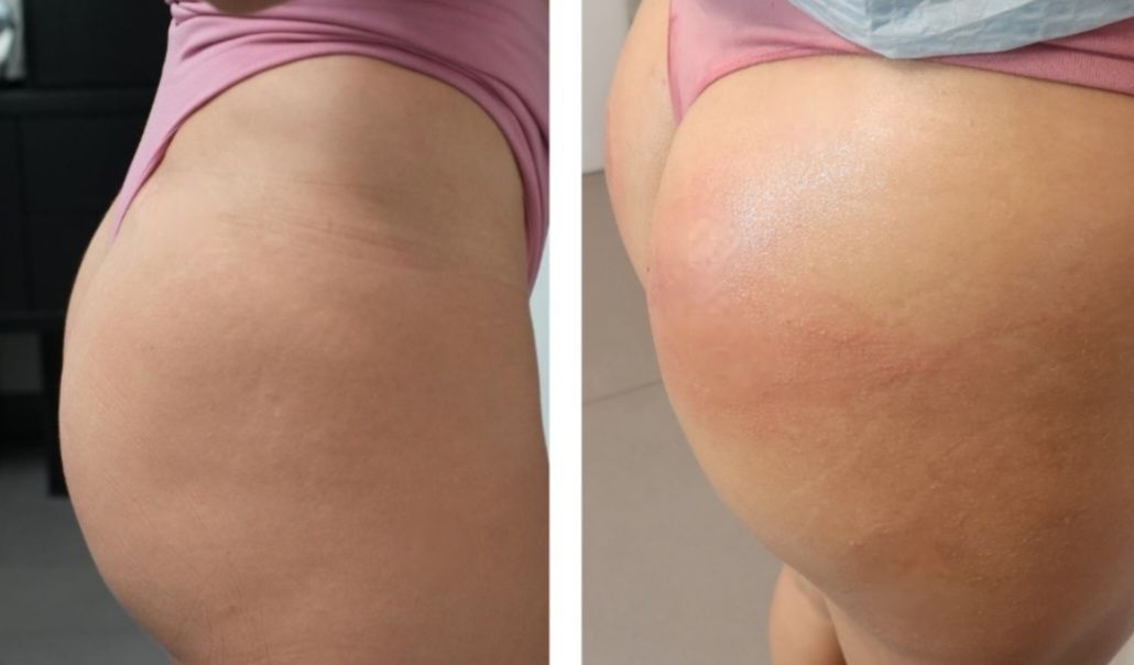 Before and after photo of Sculptra buttock butt lift,  a nonsurgical buttock butt lift done at Monaco med spa in Edgewater Midtown Downtown Brickell and Miami, FL