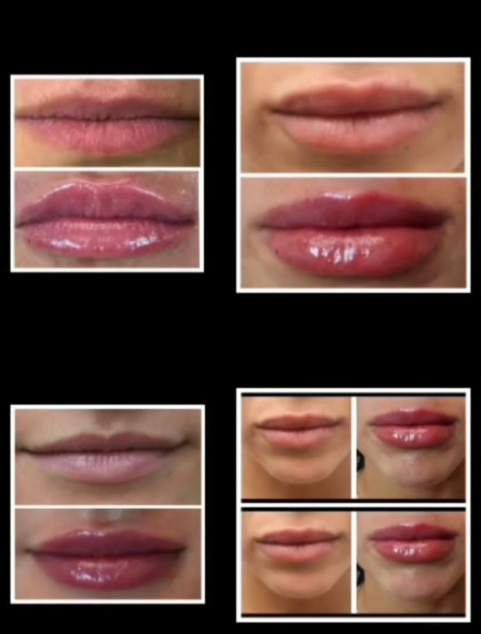 Lip Fillers By Dr. Barrueta Image of beofre and after lip filler by dr. barrueta of Monaco MedSpa, Miami, FL.