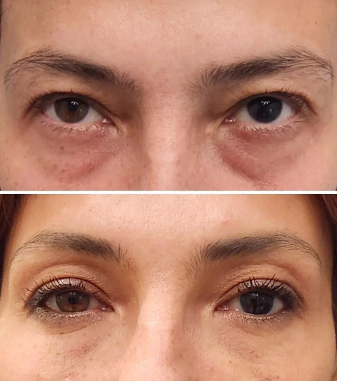 microneedling with radiofrequency, Before and After photo, Monaco Medspa in Midtown Edgewater Miami, FL, Morpheus8  Eyelids, tear trough filler, undereye filler, eye filler, lower eyelid filler, Photos of Before and After Morpheus8, Monaco med spa in Midtown Edgewater Miami, FL