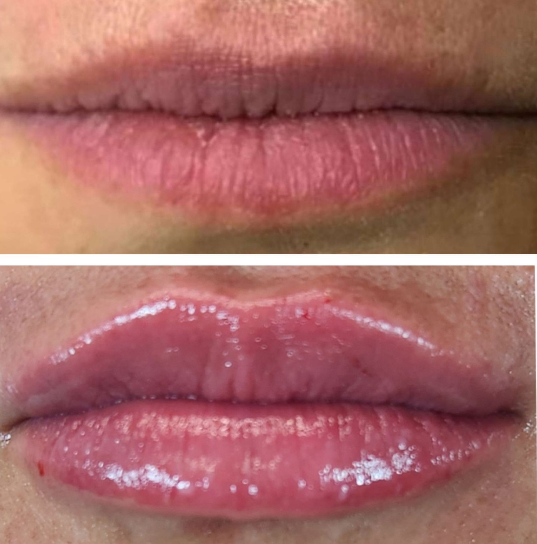 Top: Thin lips. Bottom: Fuller, glossier lips after lip filler injections perfomed by the best lip filler injector and cosmetic doctor in Miami, Fl, Dr. Barrueta, at the best med spa in Brickell Miami, FL, Monaco MedSpa.