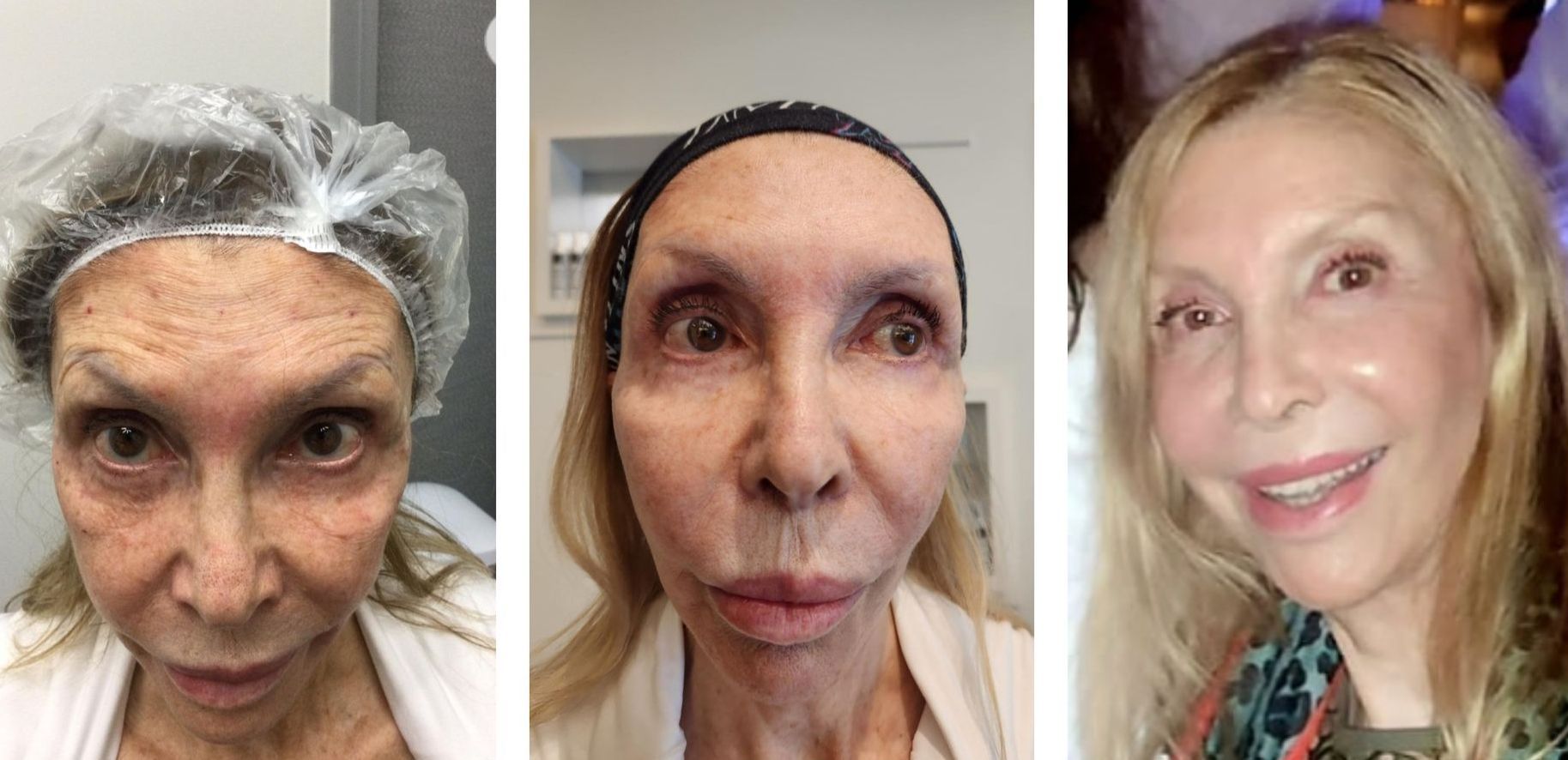 Morpheus8 Face, Eyelids & Neck
Before Any Treatments, Before First Morpheus8 Treatment & 8 months After All Treatements Were Completed. Treatments occurred from June 2022 - November 2023 and included: Two Morpheus8 Face, Eyelids & Neck Treatment Sessions, Three Lumecca IPL Photofacial Treatments To Treat Hyperpigmentation/Sun Spots, Two Temple Sculptra Filler Treatment Sessions, Upper Zygoma HA Filler x 2 Syringes, Nasolabial PDO Threads Lifts x 2 Threads Per Cheek, Tear Trough & Upper & Lower Eyelid Filler x 3 Syringes, Two Eyelids, Neck & Smoker's Lines Plasma Pen Treatment Sessions & Full Face Dysport Twice. This is Dr. Barrueta's 82 year old Godmother. Many Of You May Recognize Her Because She Is Often At The Medspa Helping Out. Her Lips Were Done Decades Ago With Silicone, Not By Dr. Barrueta. The After Pic On The Left Was Taken February 2024 At Dr. Barrueta's Birthday Party. Photo of Morpheus8, botox, hyaluronic acid filler, sculptra,  plasma pen, lumecca ipl before and after at Monaco med spa in midtown, downtown, edgewater miami florida