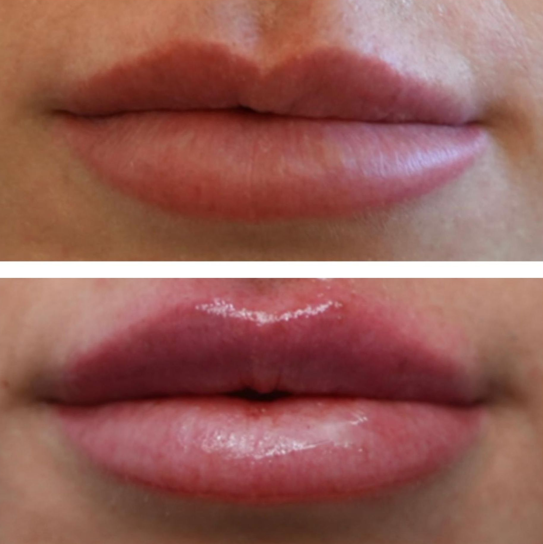 Photo of  Lip Filler, Before and Immediatelty After, performed by the best cosmetic surgeon in Miami Dr. Barrueta at the best med spa in Miami, Monaco MedSpa,  in Midtown Edgewater Miami, FL