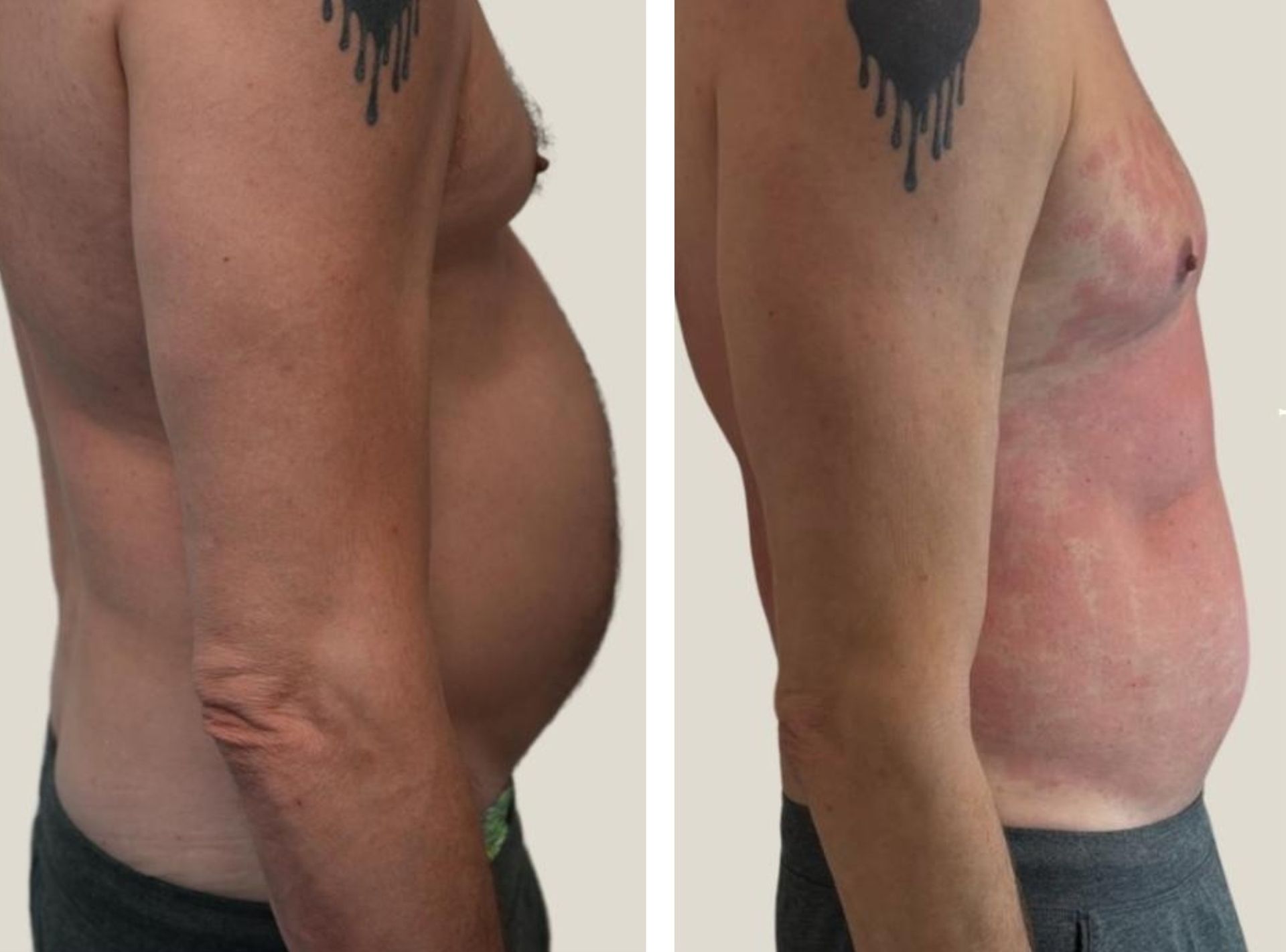 A before-and-after view of a person's stomach; the after shows a slimmer and skinnier abdomen after body countoring and body scultping with a Morpheus8 microneedling with radiofrequency procedure performed by the best cosmetic doctor in Miami, Fl, Dr. Barrueta, at the best med spa in Miami, FL, Monaco MedSpa.