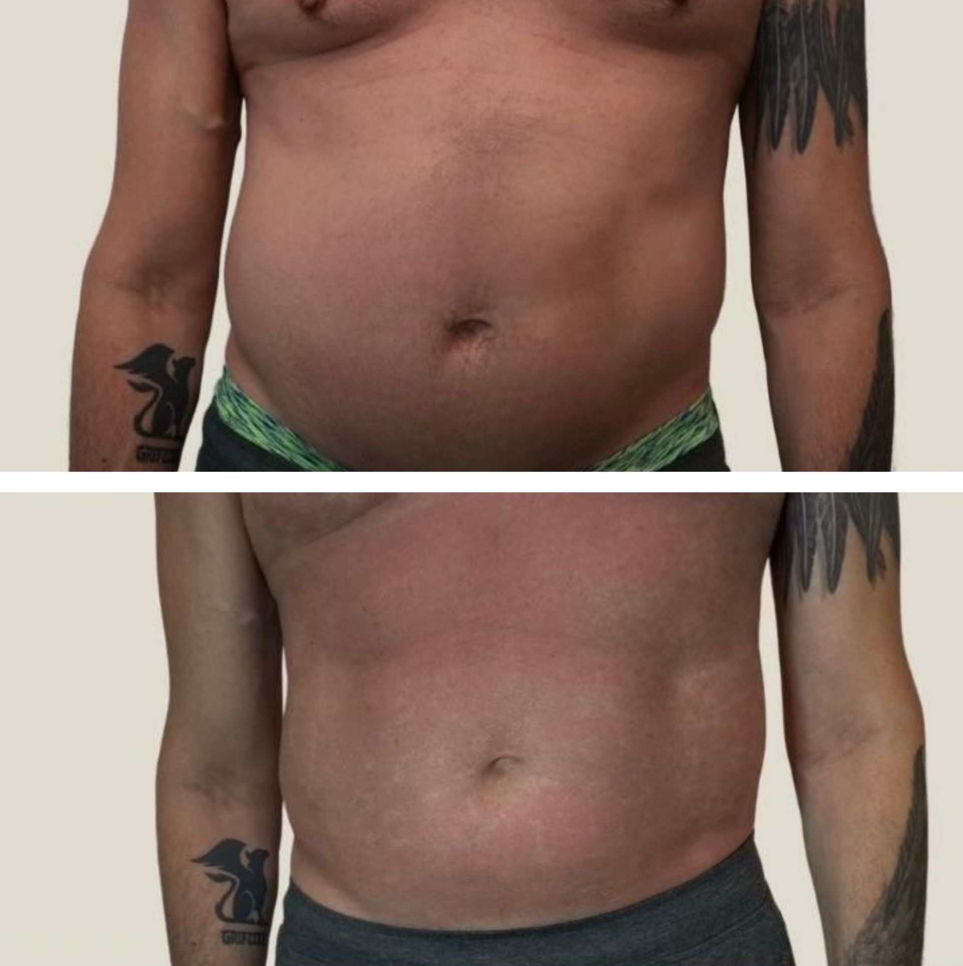 A before-and-after view of a person's stomach; the after shows a slimmer and skinnier abdomen after body countoring and body scultping with a Morpheus8 microneedling with radiofrequency procedure performed by the best cosmetic doctor in Miami, Fl, Dr. Barrueta, at the best med spa in Miami, FL, Monaco MedSpa.