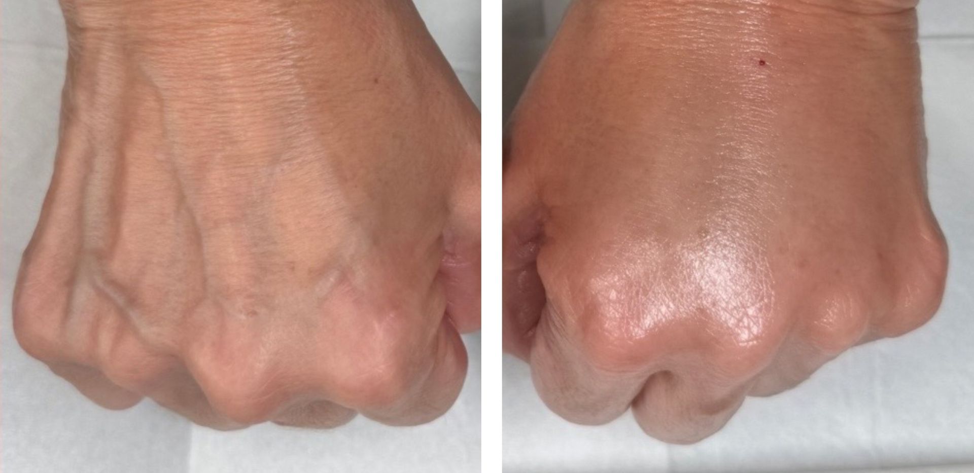  before and after photos of a hand demonstarting the rejuvenating effects of hand filler by Dr. Barrueta the best cosmetic injector doctor in Miami at the best med spa in Miami, Monaco MedSpa