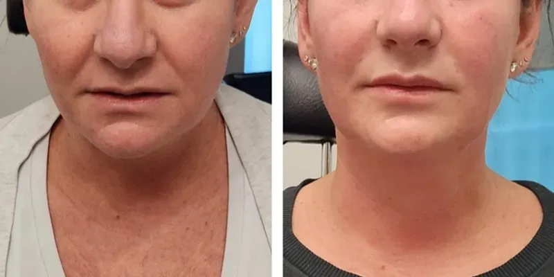 botulinum toxin, dysport, botox, Before and After, Monaco Medspa in Midtown Edgewater Miami, FL, trapezius botox, barbie botox, shoulder slimming botox, Nose botox, nasal slimming botox, nose tip botox, Undereye botox, microbotox, lower eyelid botox, lower eyelid microbotox, marionette line botox, DAO botox, Chin botox, lower face botox, Upper Botox Lip Flip botox, lip flip, lip flip botox, Jawline Nefertiti botox, Neck Bands botox, neck bands botox, nefertiti botox, platysmal neck band botox, anterior neck band botox, Photos of Before and After Botox, Filler, at Monaco med spa in Midtown Edgewater Miami, FL
