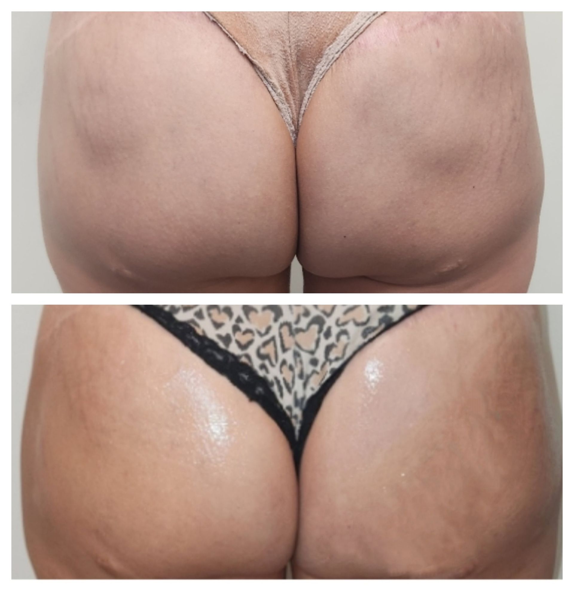 Before & After Sculptra Butt Lift, Monaco MedSpa, Miami, FL.