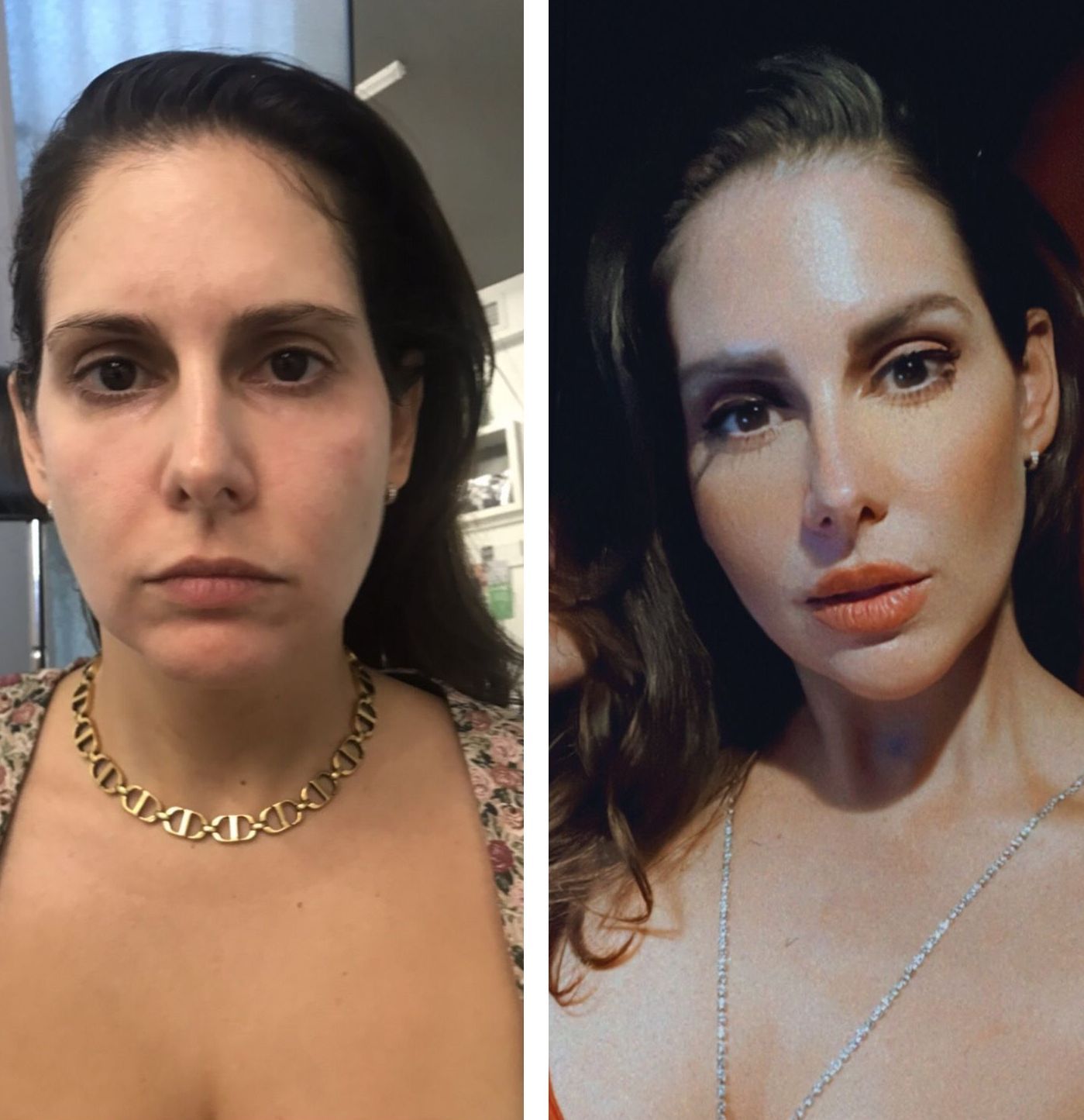 microneedling with radiofrequency, Morpheus8 Face Treatment, Morpheus 8Neck Treatment, Jaw Contouring Filler, Cheek Contouring Filler, Lip Filler, Chin Filler & Eyebrow Botox, Photos of Before and After Morpheus8, Monaco med spa in Midtown Edgewater Miami, FL