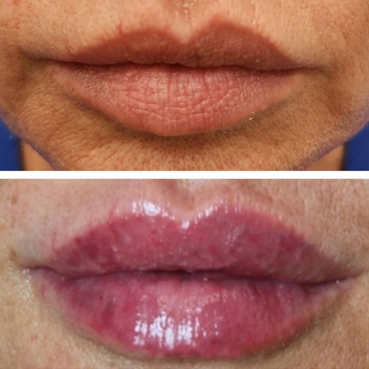 Lip Filler, Before & After 2nd Session, Monaco MedSpa, Miami, FL.