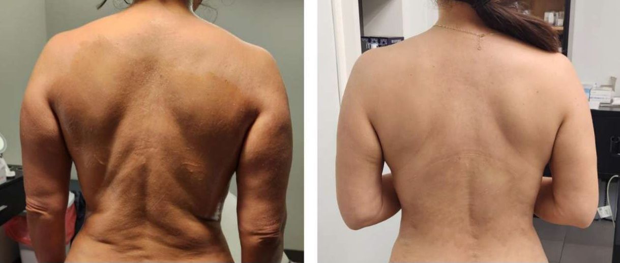 Monaco MedSpa, Miami, FL, Morpheus8 Arms, morpheus8 Back, morpheus8 Hips, Before and 4 Months After Photo. body contouring, body sculpting, microneedling with radiofrequency, Before and After, Monaco Medspa in Midtown Edgewater Miami, FL, Photos of Before and After Morpheus8, Monaco med spa in Midtown Edgewater Miami, FL