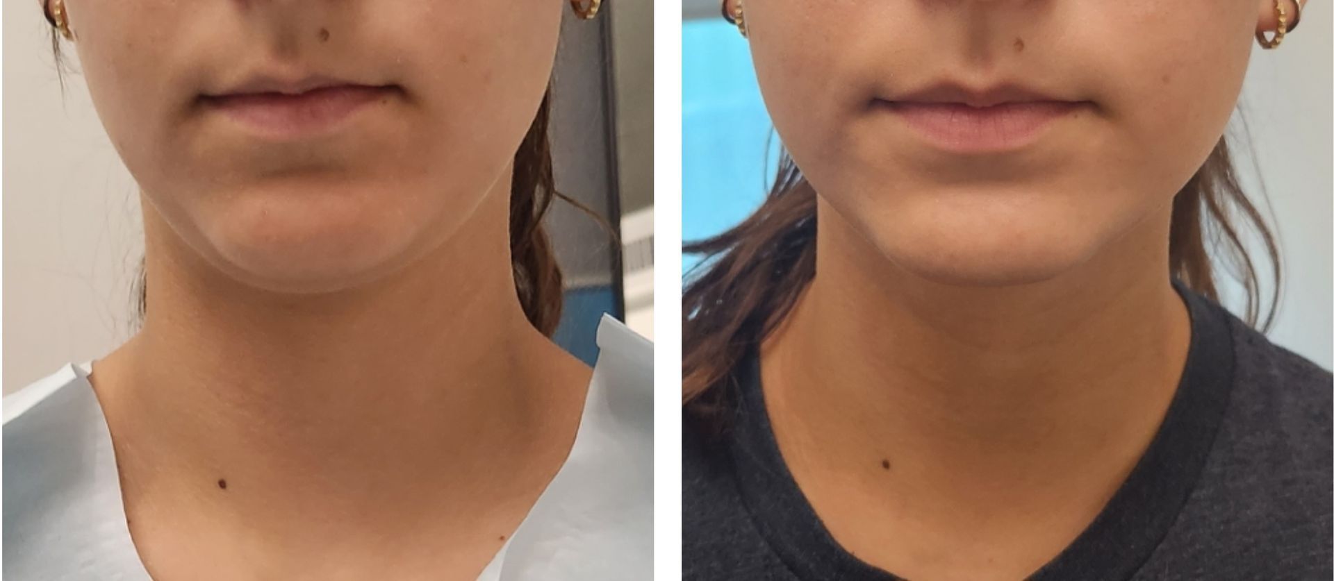 microneedling with radiofrequency, Monaco MedSpa, Miami, FL, Morpheus8, double chin, Before and After, Monaco Medspa in Midtown Edgewater Miami, FL, Photos of Before and After Morpheus8, Monaco med spa in Midtown Edgewater Miami, FL