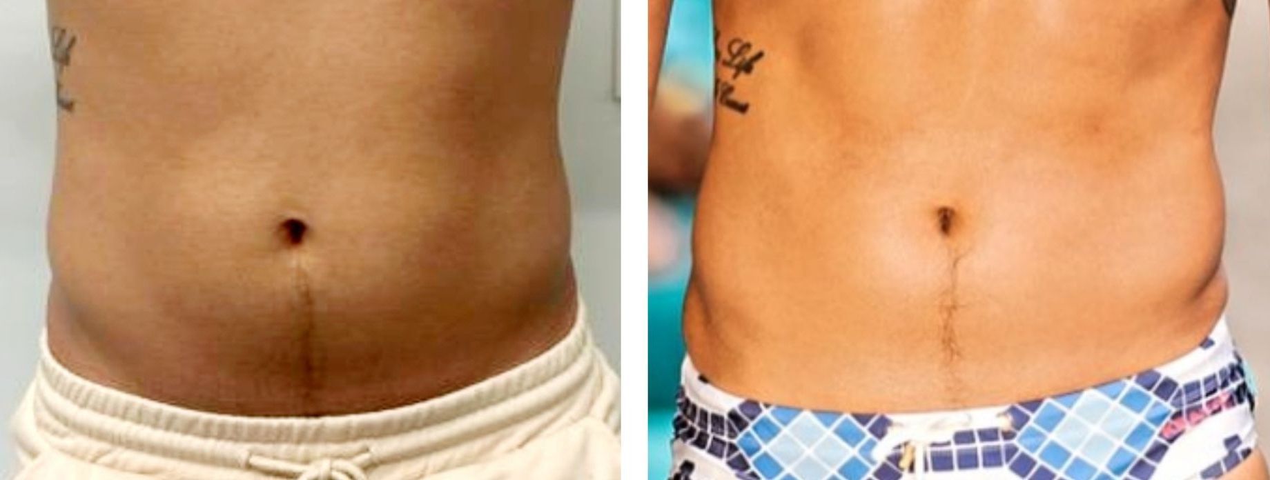 Morpheus8 Abdomen, Before & 3 Weeks After, Monaco MedSpa, Miami, FL, body contouring, body sculpting, microneedling with radiofrequency, Before and After, Monaco Medspa in Midtown Edgewater Miami, FL, Photos of Before and After Morpheus8, Monaco med spa in Midtown Edgewater Miami, FL