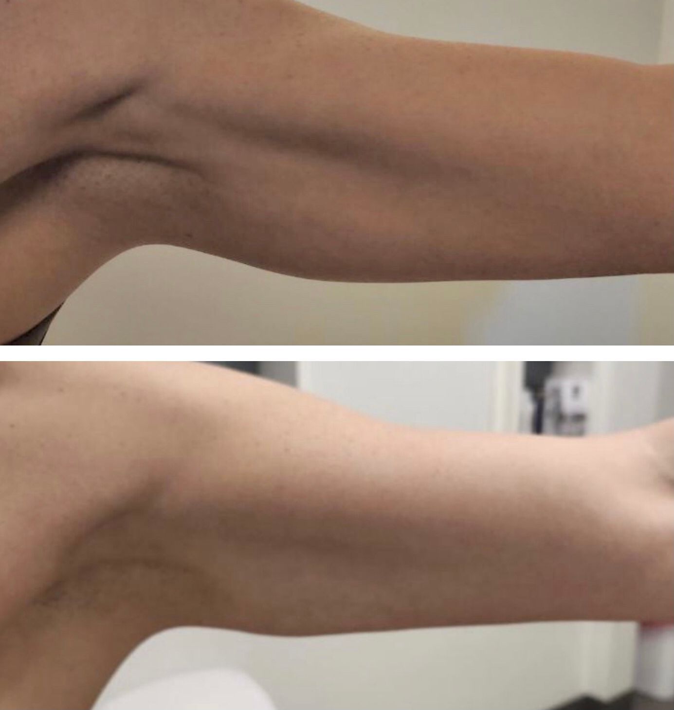 Morpheus8 Arms Before & 7 Weeks After, Morpheus8 arms, body contouring, body sculpting, microneedling with radiofrequency, Before and After, Monaco Medspa in Midtown Edgewater Miami, FL, Photos of Before and After Morpheus8, Monaco med spa in Midtown Edgewater Miami, FL