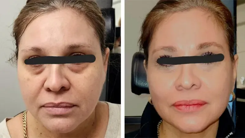 microneedling with radiofrequency, Before and After, Monaco Medspa in Midtown Edgewater Miami, FL,  Morpheus8 Face, Morpheus8  Eyelids, Morpheus8  Neck, Face Dysport, Hair PRP, Eyebrow PRP, Photos of Before and After Morpheus8, Monaco med spa in Midtown Edgewater Miami, FL