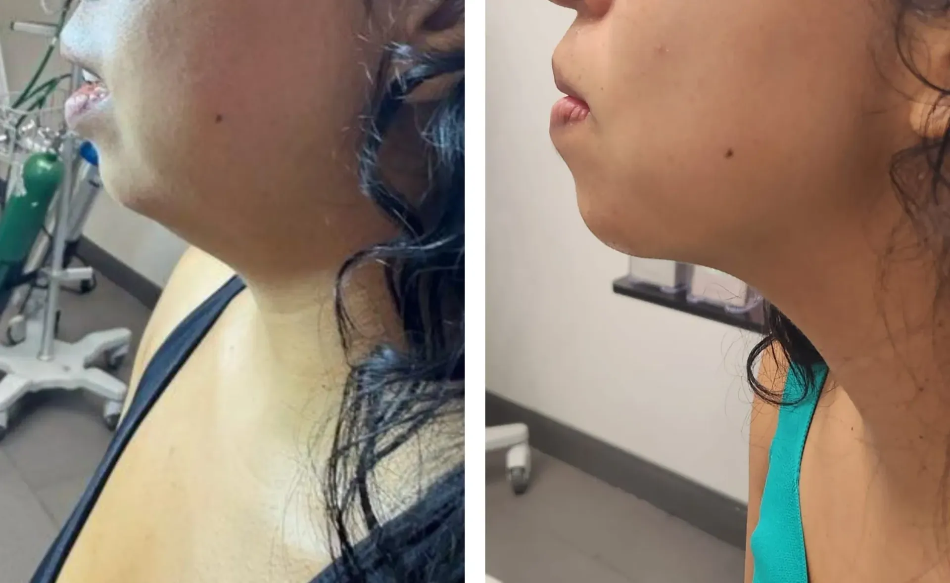 microneedling with radiofrequency, Morpheus8 Lower Face , Morpheus8 Neck Before and After, Miami, FL. microneedling with radiofrequency, Before and After, Monaco Medspa in Midtown Edgewater Miami, FL,  Morpheus8 Face, Morpheus8  Neck, Photos of Before and After Morpheus8, Monaco med spa in Midtown Edgewater Miami, FL